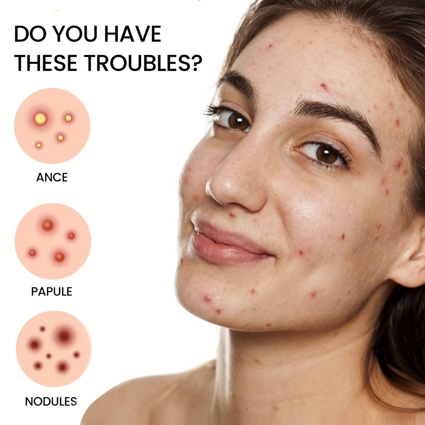 iBeaLee 1080pcs Hydrocolloid Acne Pimple Patch - Tea Tree Oil Infused, Waterproof Blemish Cover Stickers for All Skin Types, Unisex Adult, Formaldehyde-Free, Day & Night Use